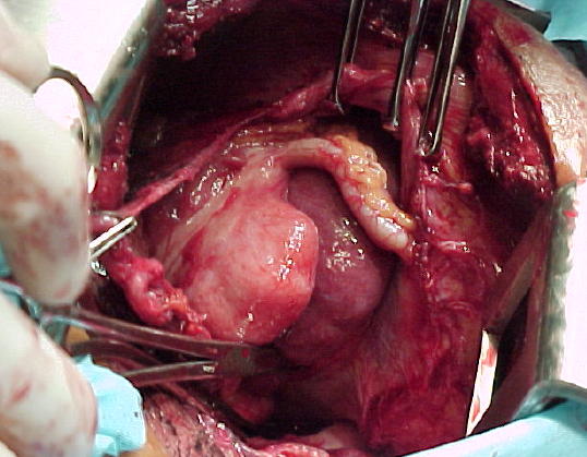 El ciego y ap�ndice ileocecal intrator�cicos