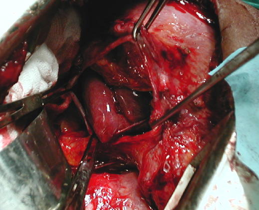 Adherencias hepaticas al anillo diafragm�tico