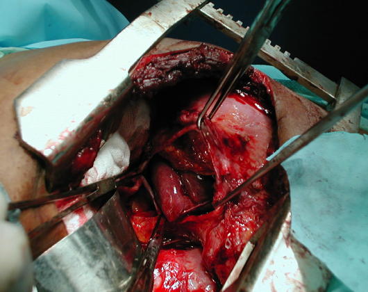 Anillo diafragm�tico de 8 cms di�metro aprox,