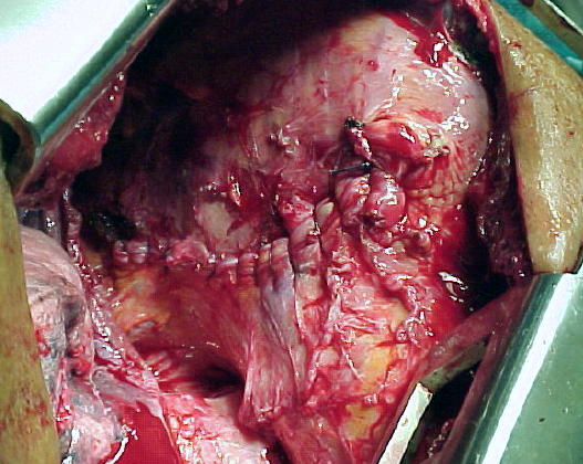 S�ntesis cont�nua del anillo diafragmatico de 8 cm. diametro mayor