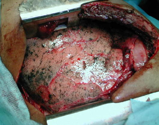 Expansi�n pulmonar ocupando el espacio pleural