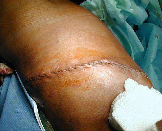 El drenaje tor�cico y el cateter de epidural reincorpoan activamente al paciente a su rehabilitaci�n posoperatoria.