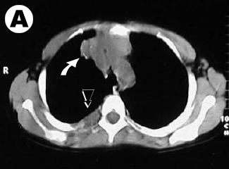 Corte tomografico se aprecia la lesion mediastinal y osea costal porterior