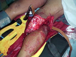 Amputaci�n traumatica miembro Inferior Izquierdo