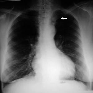 Rx Torax Bocio Intratoracico