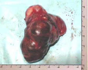 Bocio Tiroideo intratoracico