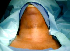 Cervicotomia transversa