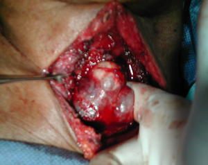 Cervicotomia transversa maniobra lager