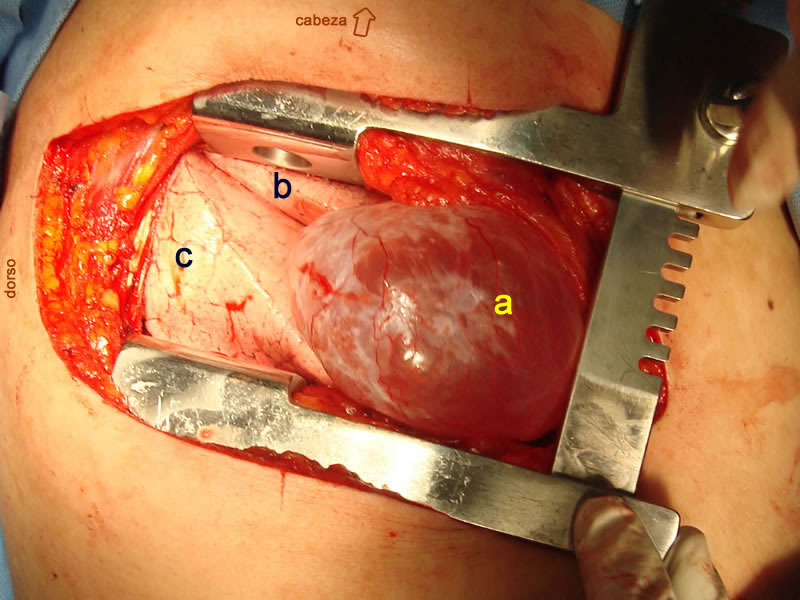 Bula Pulmonar emerge a travez toracotomia