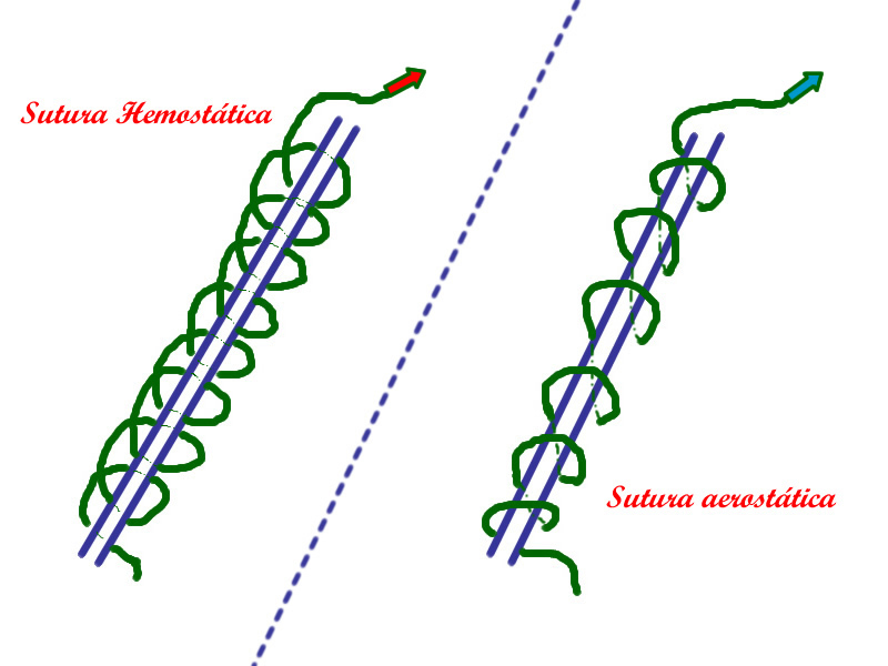 esquema sutura empleada