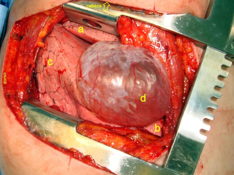 Bula enfisematosa y los tres lobulos pulmonares