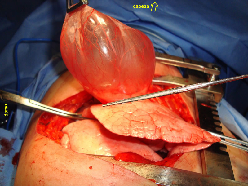 Bula pulmonar, inicio de la reseccion