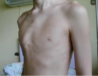 Fotografia del pectus carinatum