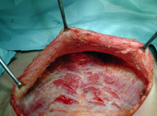 Incisi�n trasversa, La diseccion de piel y subcutaneo