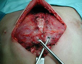 Disecci�n pectoral