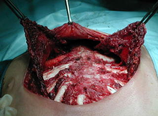 La deformidad de la pared y esternon