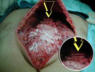 Osteotomia transversa esternal