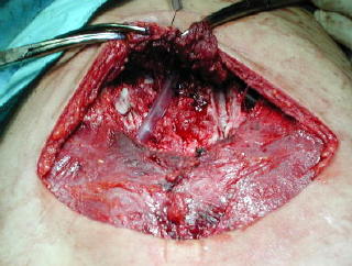 Rectos en pinzas, el drenaje y la sintesis del plano pectoral