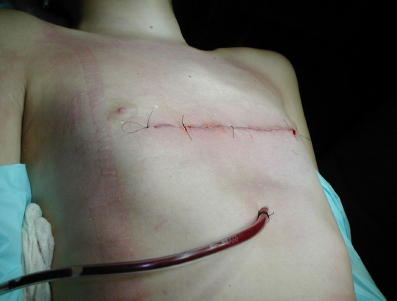 Foto del t�rax Post operatorio