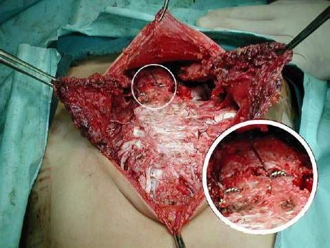 Sintesis de Osteotom�a