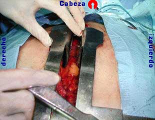 Bronquio del lobulo superior en referencias