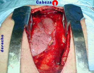 Cierre del mu��n bronquial