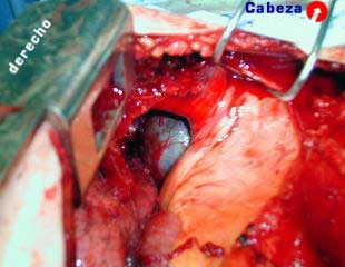 Secci�n del ligamento triangular