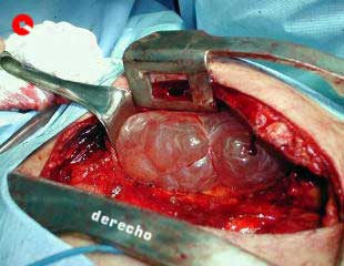 cierre de la pared toracica