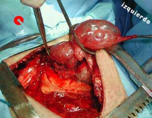 Fotografia de la pieza resecada