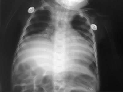 Rx torax: eventracion diafragma