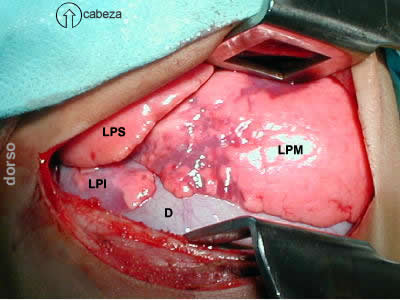 eventracion diafragma