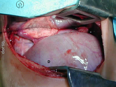 eventracion diafragma