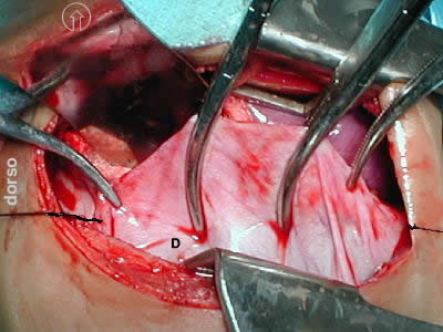 eventracion diafragma plicatura