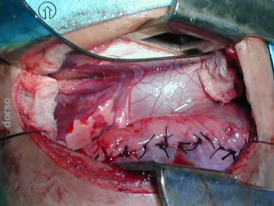 eventracion diafragma plicatura