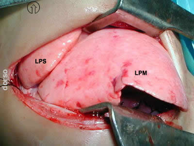 eventracion diafragma