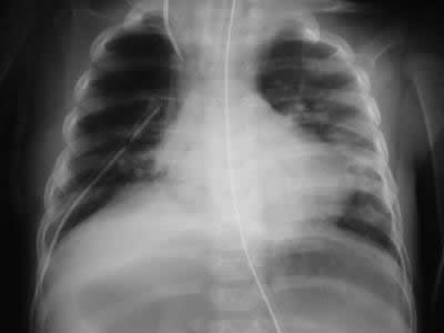 Rx post operatorio eventracion diafragma