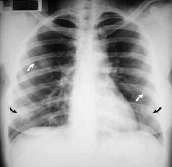 Rx torax: tumor del pulmon