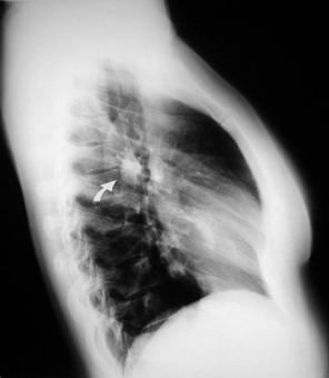 Rx lateral torax nodulos pulmonares hodgkin