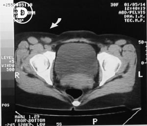 Corte Tomogr�fico D pelvico