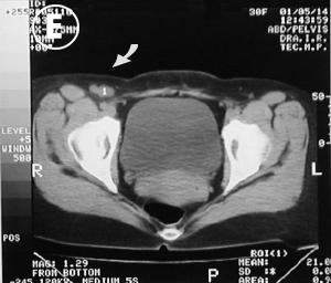 Corte tomografico E pelvico