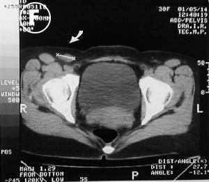 Corte Tomogr�fico F pelvico