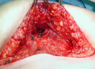 diseccion colgajo cutaneo