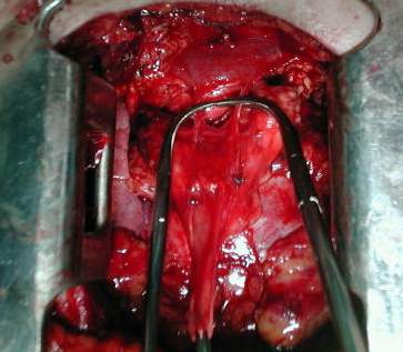 Ligadura y seccion venas timicas