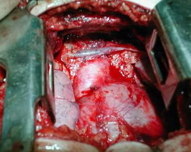 Reseccion grasa mediastinica