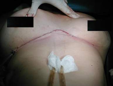 Sintesis de los planos y drenajes pleurales