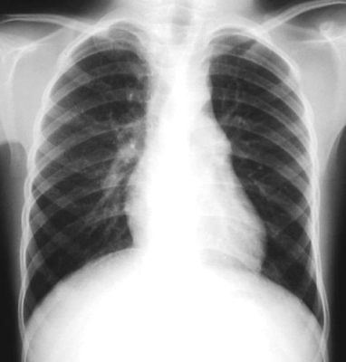 Radiologia PA Pre-operatoria