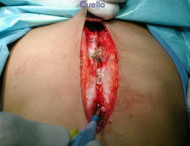 Incision longitudinal medio esternal