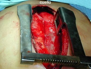 Explorando Mediastino