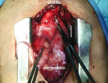 Ligadura y seccion venas timicas