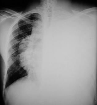 Rx torax: tumor del pulmon